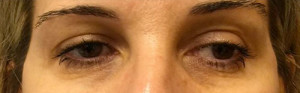 Blepharoplasty