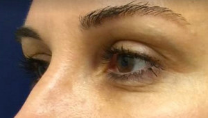 Blepharoplasty