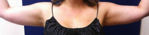Liposuction Case 4595 After Photo Liposuction