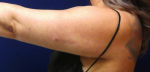 Liposuction Case 4595 After Photo Liposuction