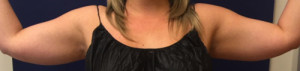 Liposuction Case 4595 Before Photo Liposuction