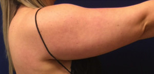 Liposuction Case 4595 Before Photo Liposuction