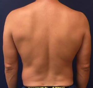 Liposuction Case 4654 Before Photo Liposuction