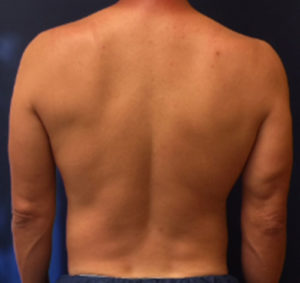 Liposuction Case 4654 After Photo Liposuction