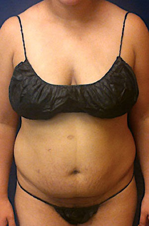 Abdominoplasty