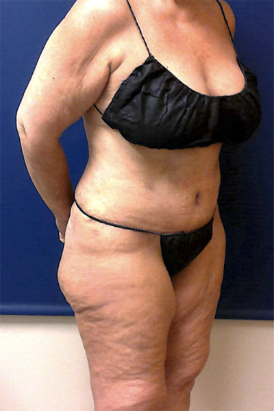 Abdominoplasty