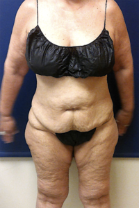 Abdominoplasty