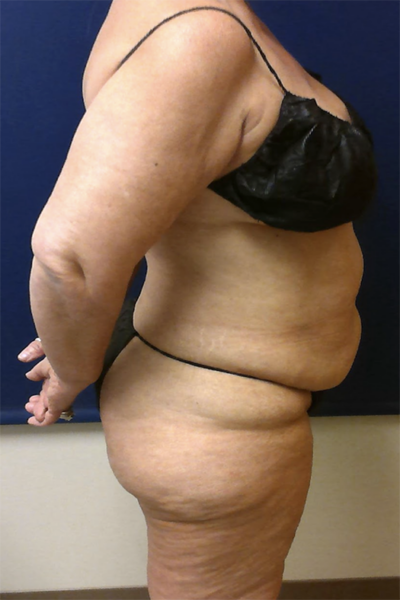 Abdominoplasty Case 5531 Before Photo Abdominoplasty
