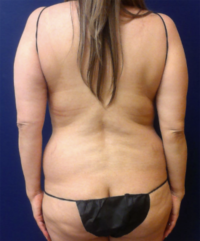 Abdominoplasty