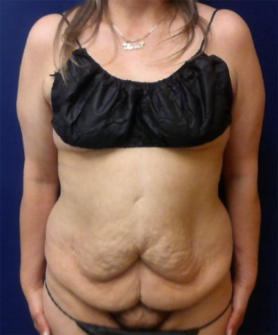 Abdominoplasty