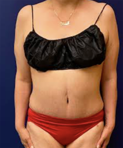 Abdominoplasty