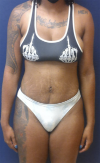 Abdominoplasty