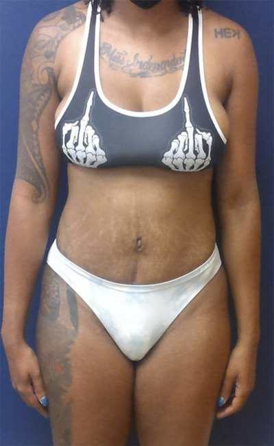 Abdominoplasty