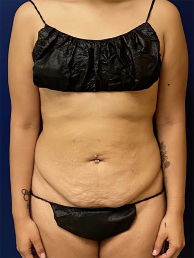 Abdominoplasty Case 5548 Before Photo Abdominoplasty