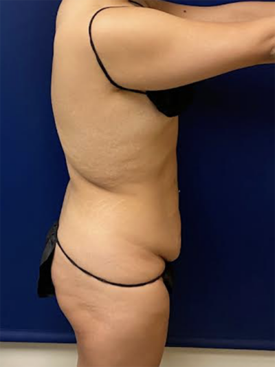 Abdominoplasty Case 5548 Before Photo Abdominoplasty
