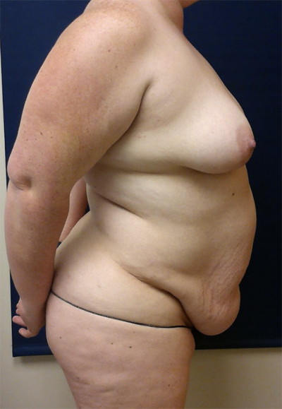 Abdominoplasty Case 5566 Before Photo Abdominoplasty