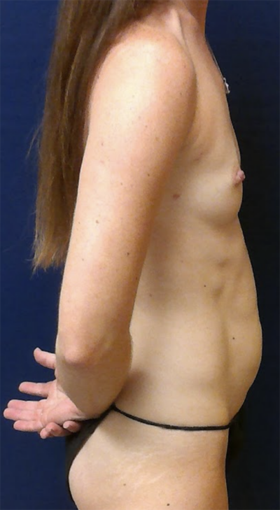 Abdominoplasty Case 5573 Before Photo Abdominoplasty
