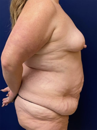 Abdominoplasty