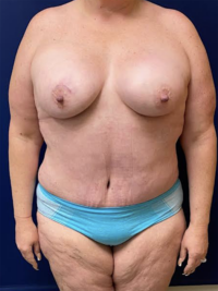 Abdominoplasty