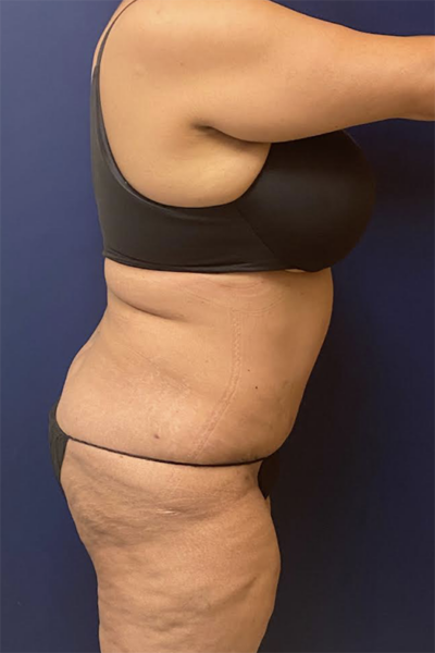 Abdominoplasty Case 5594 After Photo Abdominoplasty