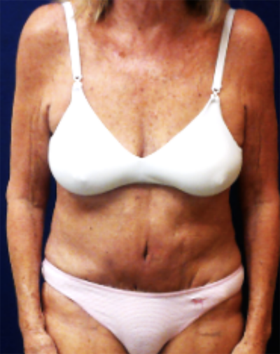 Abdominoplasty