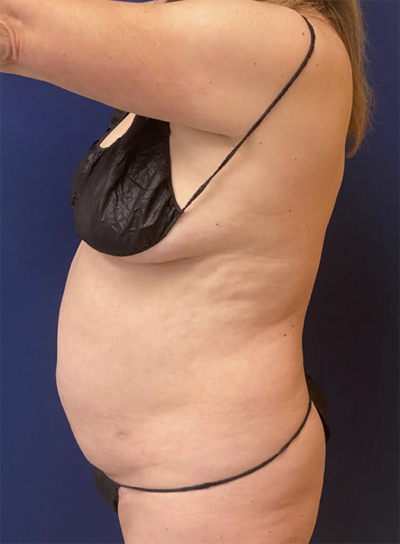 Abdominoplasty