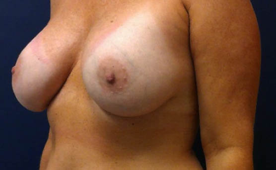 After Breast Augmentation Photo