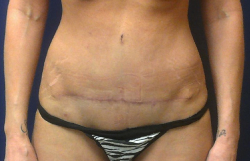 After Tummy Tuck Photo