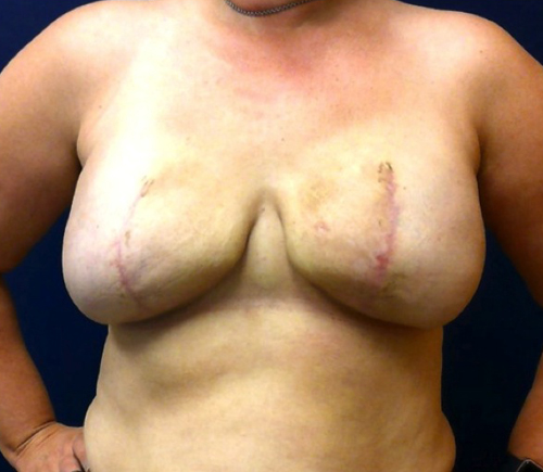 After Breast Reconstruction Photo