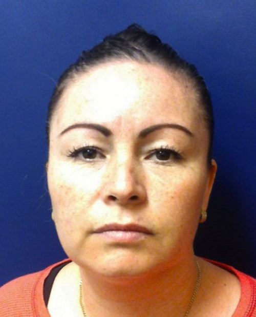 Eyelid Surgery Before and After Photo