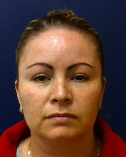 Eyelid Surgery Before and After Photo