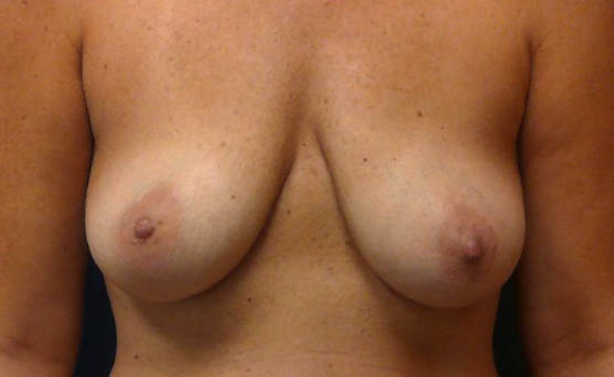 Before Breast Augmentation Photo