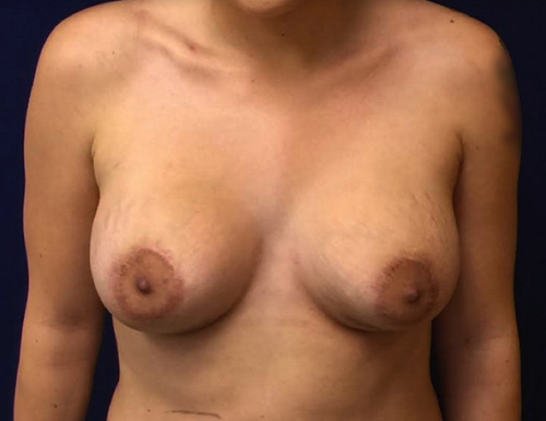 After Breast Lift Photo