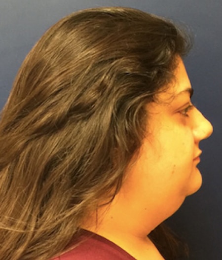 Before Face Lift Photo Face Lift Before Photo - Actual Patient by Dr. Chen in Newport Beach