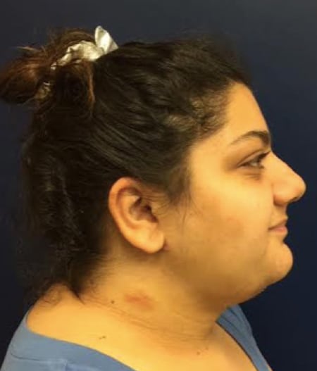 After Face Lift Photo Face Lift After Photo - Actual Patient by Dr. Chen in Newport Beach