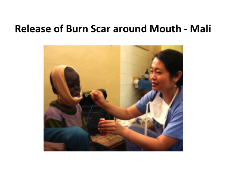 Release of Burn Scar Around Mouth - Mali