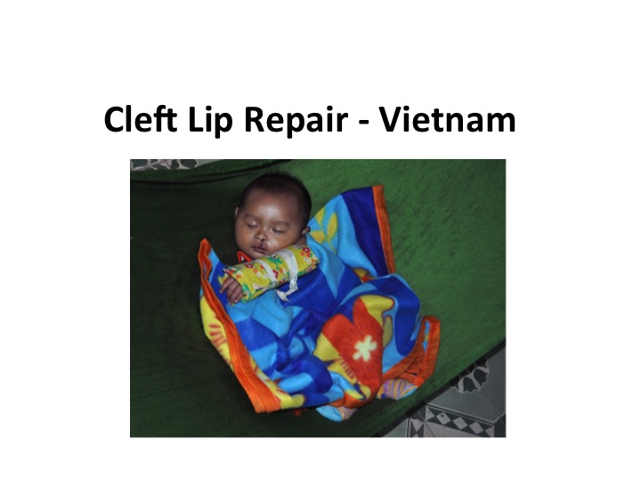 Cleft Lip Repair Vietnam